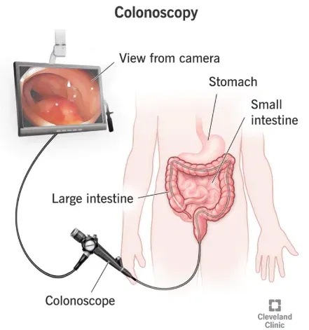 Clinical reasons and indications for a colonoscopy screening