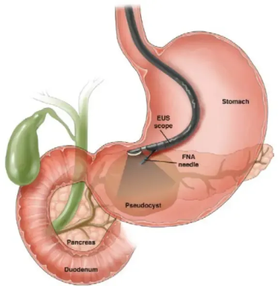 Medical illustration of a stomach with an endoscopic ultrasound scope inserted