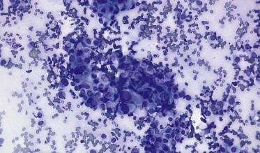 Endoscopic Ultrasound and Pancreatic Tumors: A Precision Tool for Diagnosis and Staging