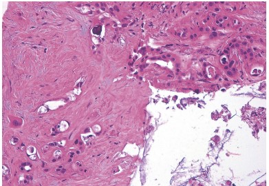 Endoscopic Ultrasound-Guided Fine-Needle Biopsy (EUS-FNB)