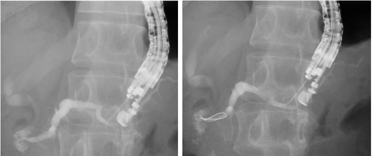 Endoscopic Ultrasound-Guided Drainage of the Biliary-Pancreatic Ductal Systems and Gallbladder