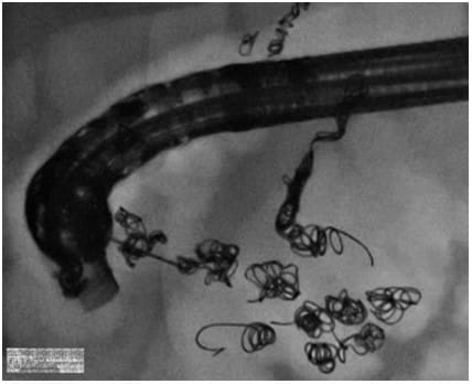 EUS-Guided Anastomosis, Drainage, and Vascular Interventions