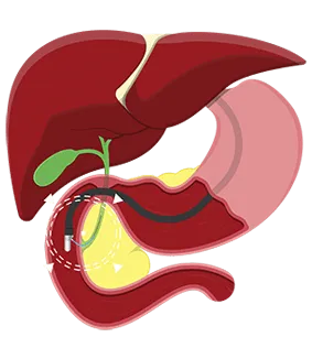Medical illustration detailing the anatomical path of a side-viewing duodenoscope during an ERCP procedure, showing the scope entering the duodenum and a catheter ascending into the biliary tree