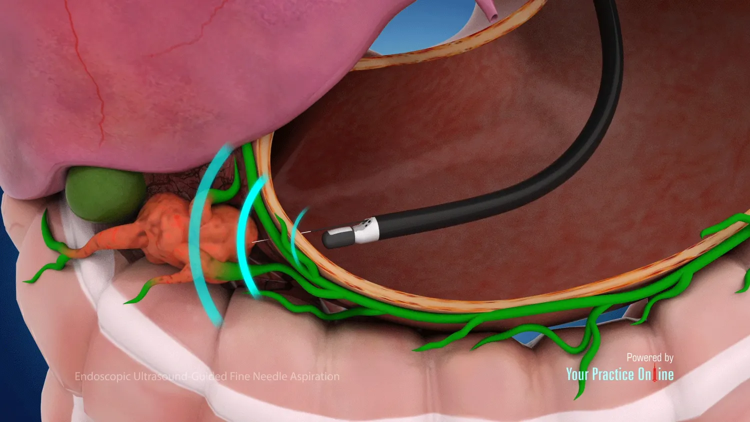 3D medical rendering displaying an echoendoscope tip within the stomach wall emitting acoustic ultrasound waves to pinpoint an adjacent tumor mass next to lymphatic networks