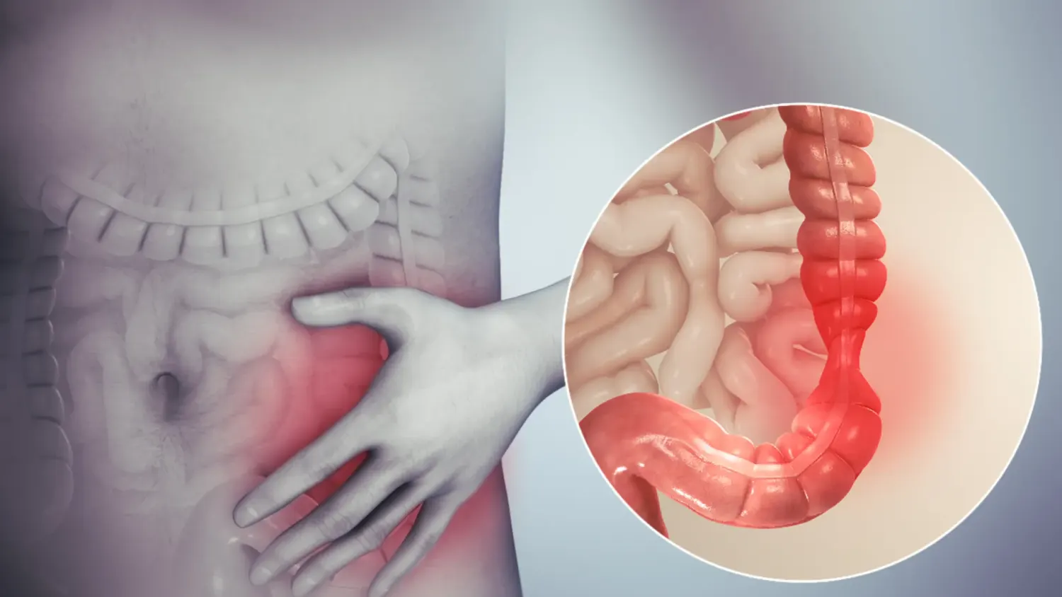 Understanding Irritable Bowel Syndrome (IBS)