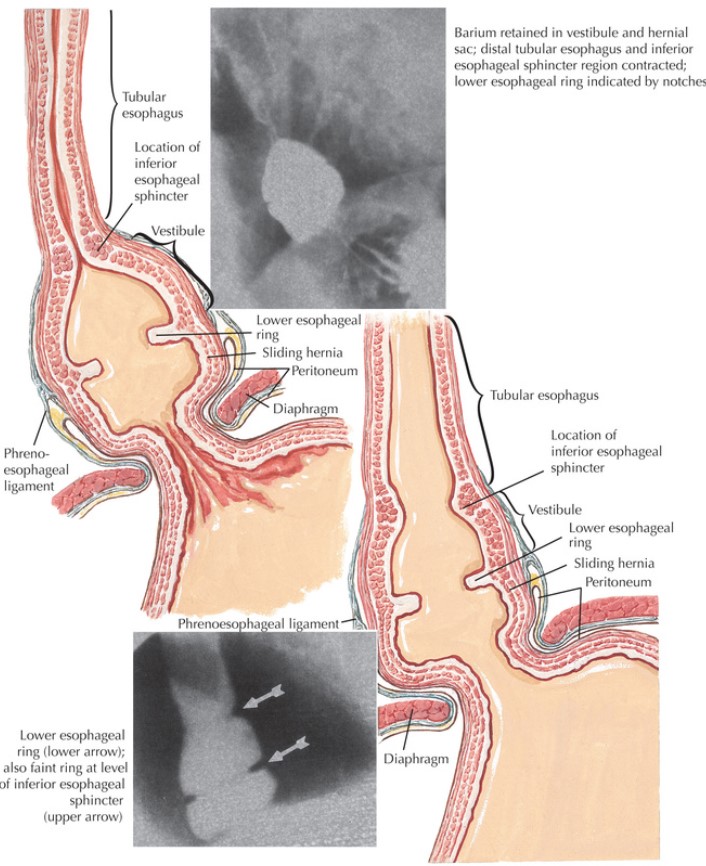 Esophageal Rings