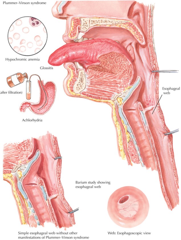 Plummer-Vinson Syndrome