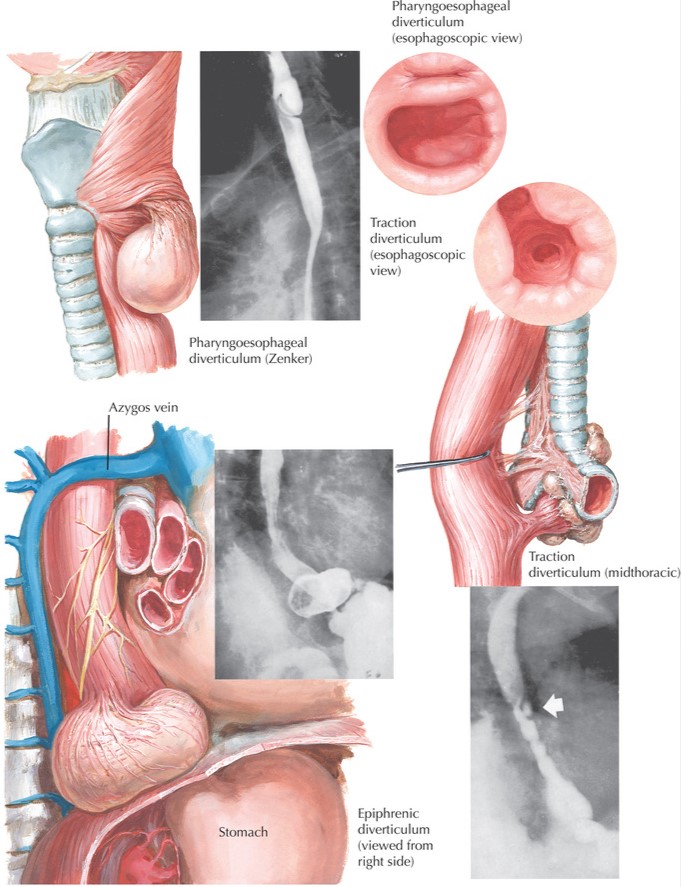 Esophageal Diverticula