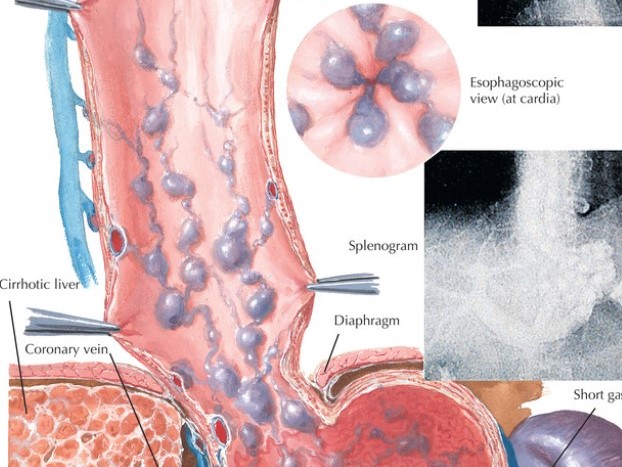 Esophageal Varicosities: Causes, Symptoms, and Treatment