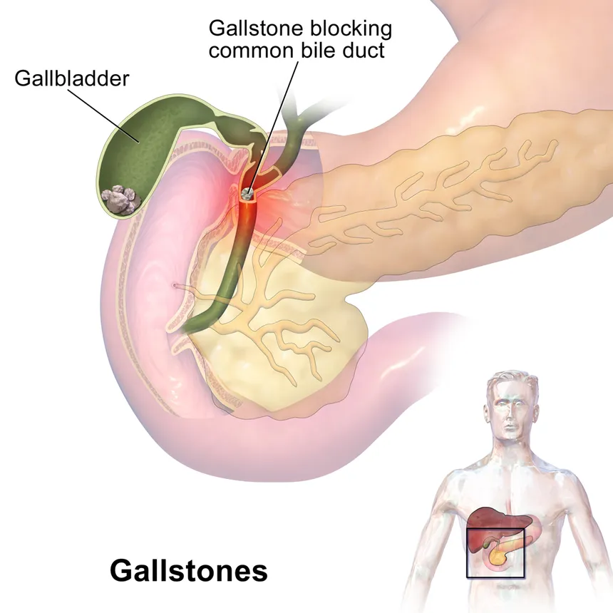 Biliary Stones Treatment