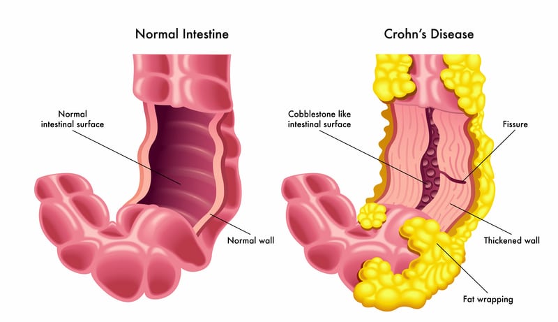 Crohn's Disease Treatment Karachi | Best Gastroenterologist Dr. Ali Taj