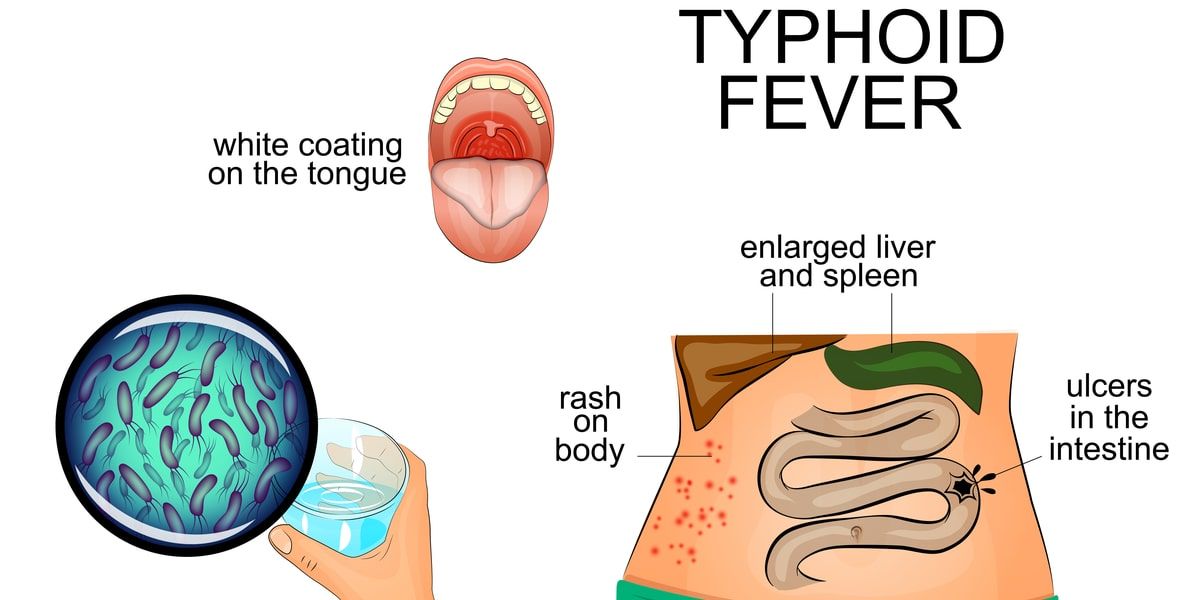 Typhoid Treatment in Karachi - Expert Gastroenterology Care