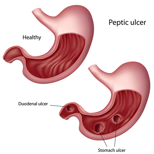 Pait Mein Ulcer Ka Ilaj: Symptoms and Treatment - Expert Gastroenterology Care