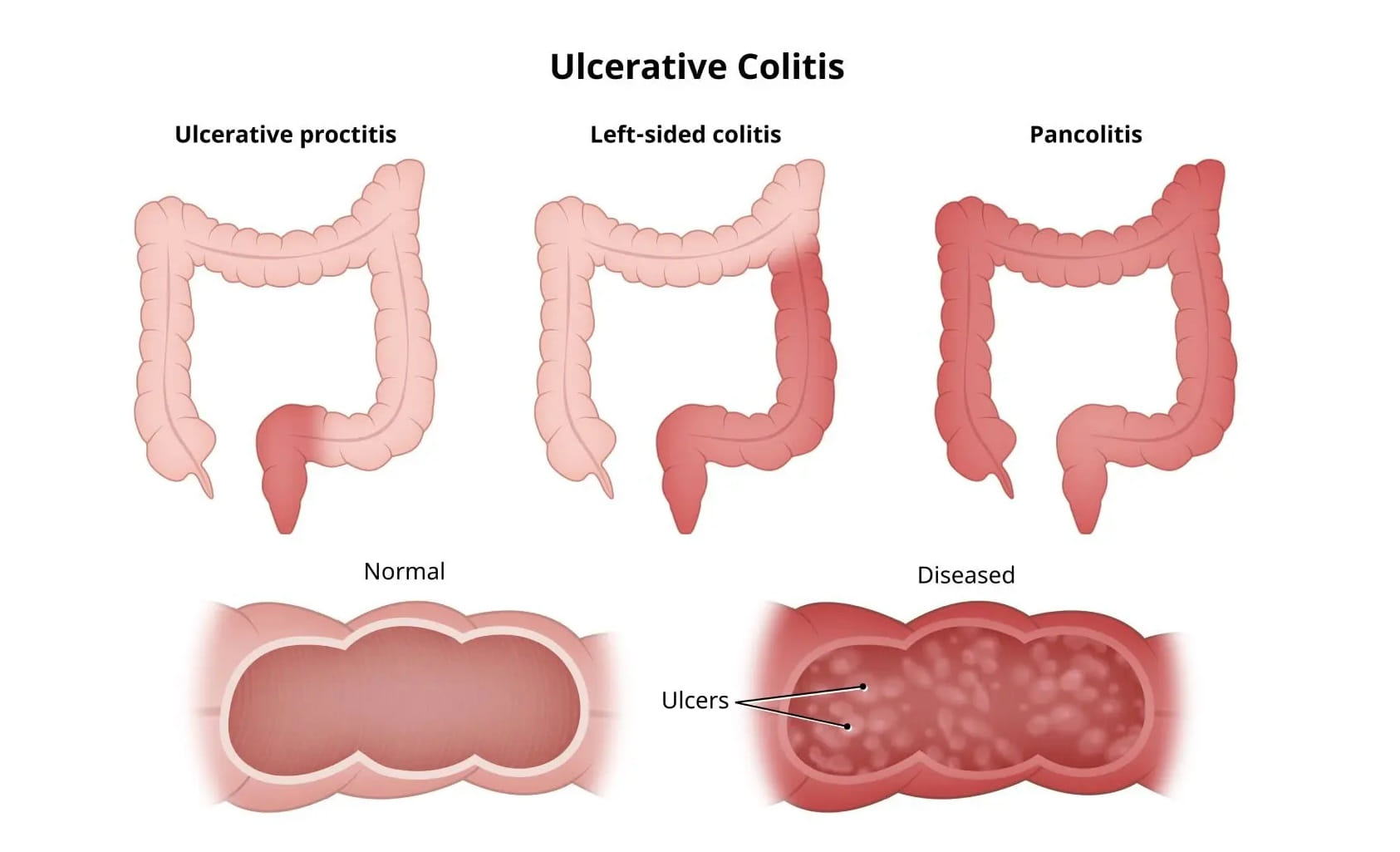 Ulcerative Colitis Treatment Karachi | Expert IBD Doctor - Dr. Ali Taj